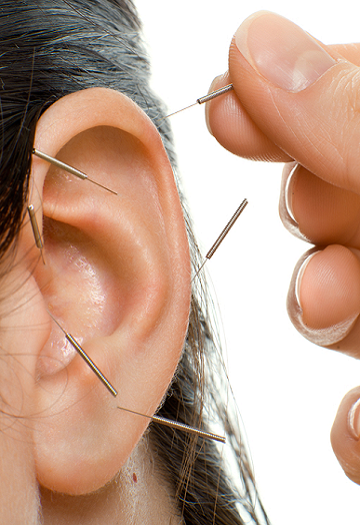 Auricular Acupuncture